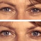 Botox uygulamaları