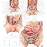 İnmemiş testis nedir?