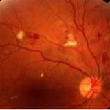 Şeker hastalığı gözü nasıl etkiler? (diabetik retinopati)