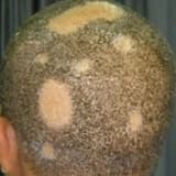 Saçkıran (alopesi areata)