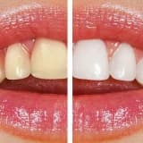 Diş beyazlatmanın (bleaching) ömrü ne kadardır ?