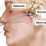 Hipofiz adenomu nedir? Tedavisi nasıl yapılır?