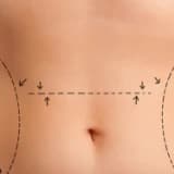 Karın germe (abdominoplasti) ve sonrası