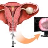 Tüp bebekte gebeliği arttıran ilginç bir yöntem: histeroskopik endometrial hasarlama