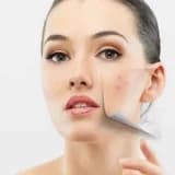 Dermabrazyon..