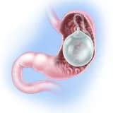 İntra gastrik balon nedir?