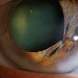 Puppıloplasty nedir?