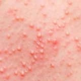 Genital siğiller (HPV) enfeksiyonu nedir?