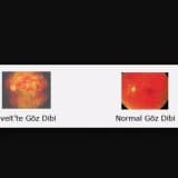 Üveit nedir? Tedavisi nasıldır?