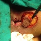 Rektum kanseri, tanı ve tedavisi