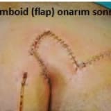 Pilonidal sinüs (kıl dönmesi) ve cerrahi tedavisi