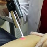Uzman hekim tarafından yapılan lazer epilasyon zararlı mı ?