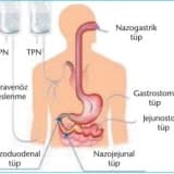 Perkütan endoskopik gastrostomi