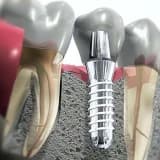 Diş implantı ( dental implant)