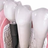 Dental implant nedir ?