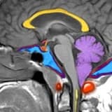 Chiari tip1 Malformasyonu