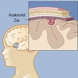 Araknoid kist nedir? Nasıl teşhis edilir?