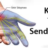 Karpal tünel sendromu (el bileği seviyesinde sinir sıkışması)