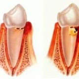 PERIODONTOLOJI