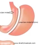 DİYABETE AMELİYATLI TEDAVİ…