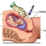 Amniyosentez (Amniosentez) nedir ? Neden yapılmalıdır?