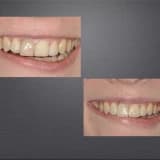 implant Uygulama Alanları