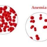 Anemi