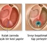 Kulak zarına tüp takılması