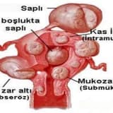 KAPALI (LAPAROSKOPİK) MYOM AMELİYATLARI