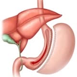 Tüp Mide Ameliyatı – Sleeve Gastrectomy