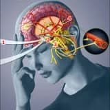 Trigeminal Nevralji nedir?
