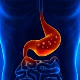 Morbid Obezitenin Cerrahi Tedavisinde Tüp Mide ve Gastrik Bypass