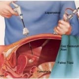 Laparoskopi Nedir? Laparoskopik Uygulamalar Nelerdir?