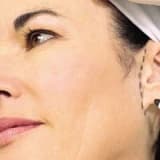 Kepçe Kulak Estetiği (Ameliyatsız İple Kulak Estetiği – Otoplasti)