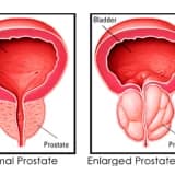İYİ HUYLU PROSTAT BÜYÜMESİ (BPH)