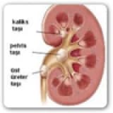 Taş hastalığı nedir? Oluşmasında etkili faktörler nelerdir?