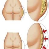 Lipoliz Nedir? Nasıl Uygulanır?