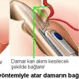 HEMOROİD HASTALIĞI VE HEMOROİD ARTER LİGASYONU (ağrısız (kesme işlemi olmadan ) kanamasız tedavi )