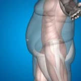 Obezite sonuçları ve obezite cerrahisinin faydaları: gastrik bypass (mide küçültme) ve sleeve gastrektomi (tüp mide)