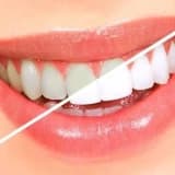 Bleaching (diş beyazlatma) işlemi