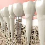 İmplant çürür mü , implant düşer mi ve implant konusunda daha fazla merak ettiğiniz tüm cevaplar