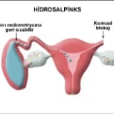 Hidrosalpinks