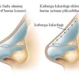 BURUN DÜZELTME CERRAHİSİ (REVİZYON RİNOPLASTİ)
