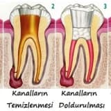 İnatçı Enfeksiyonlar Kanal Tedavisi ve Apikal Rezeksiyon