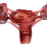 ÇİKOLATA KİSTİ ENDOMETRİOMA SİZİ KORKUTMASIN