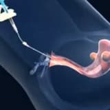 Aşılama - IUI neden yapılır ?