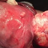 Miyoma Uteri (Rahimde Ur) Hakkında Merak Ettikleriniz
