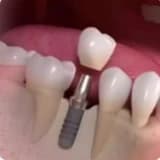 Implant (Vidalı) Diş