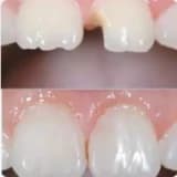 Bonding (Dental Bonding)