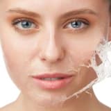 Kimyasal Peeling Nedir, Neden Yapılır ?